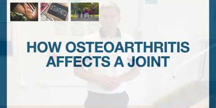 Part One: Understanding Osteoarthritis- MSK Physiotherapy