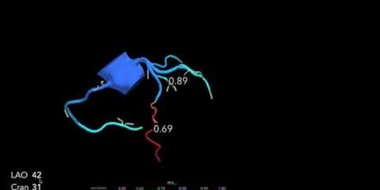 FFR-CT beat invasive conventional coronary angiography says a Cardiologist