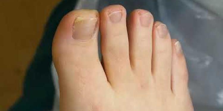 How to treat an ingrowing toenail / Involuted nail