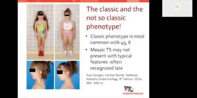 Turner syndrome: Beyond the classic XO phenotype