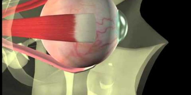 Thyroid eye disease. Squint surgery - The operation