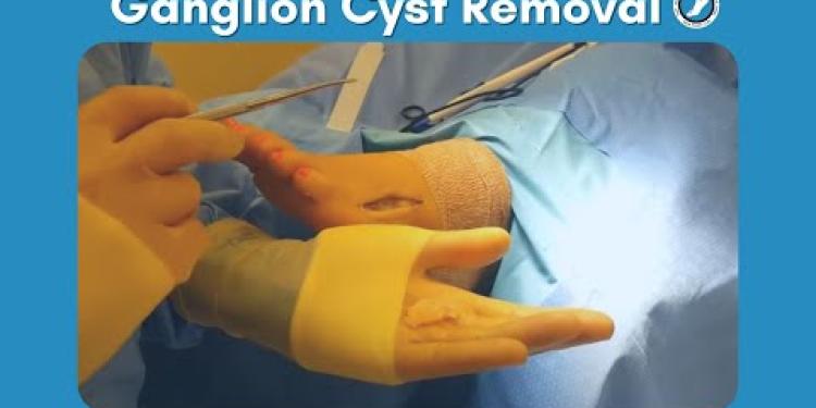 Ganglion Cyst Removal